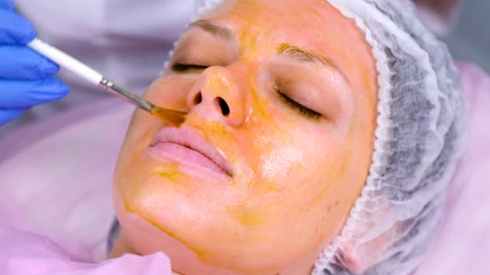 Chemical peels