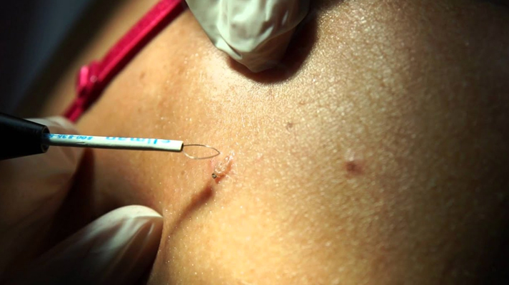 Ellman radio surgery