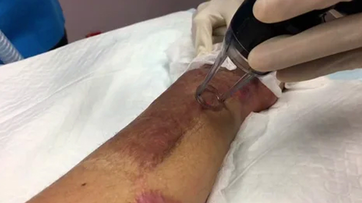 Skin grafting