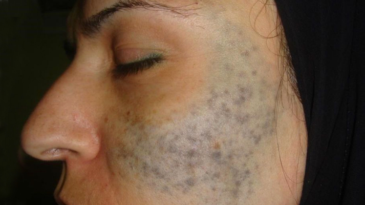 Nevus of Ota removal by Q switch ND Yag laser